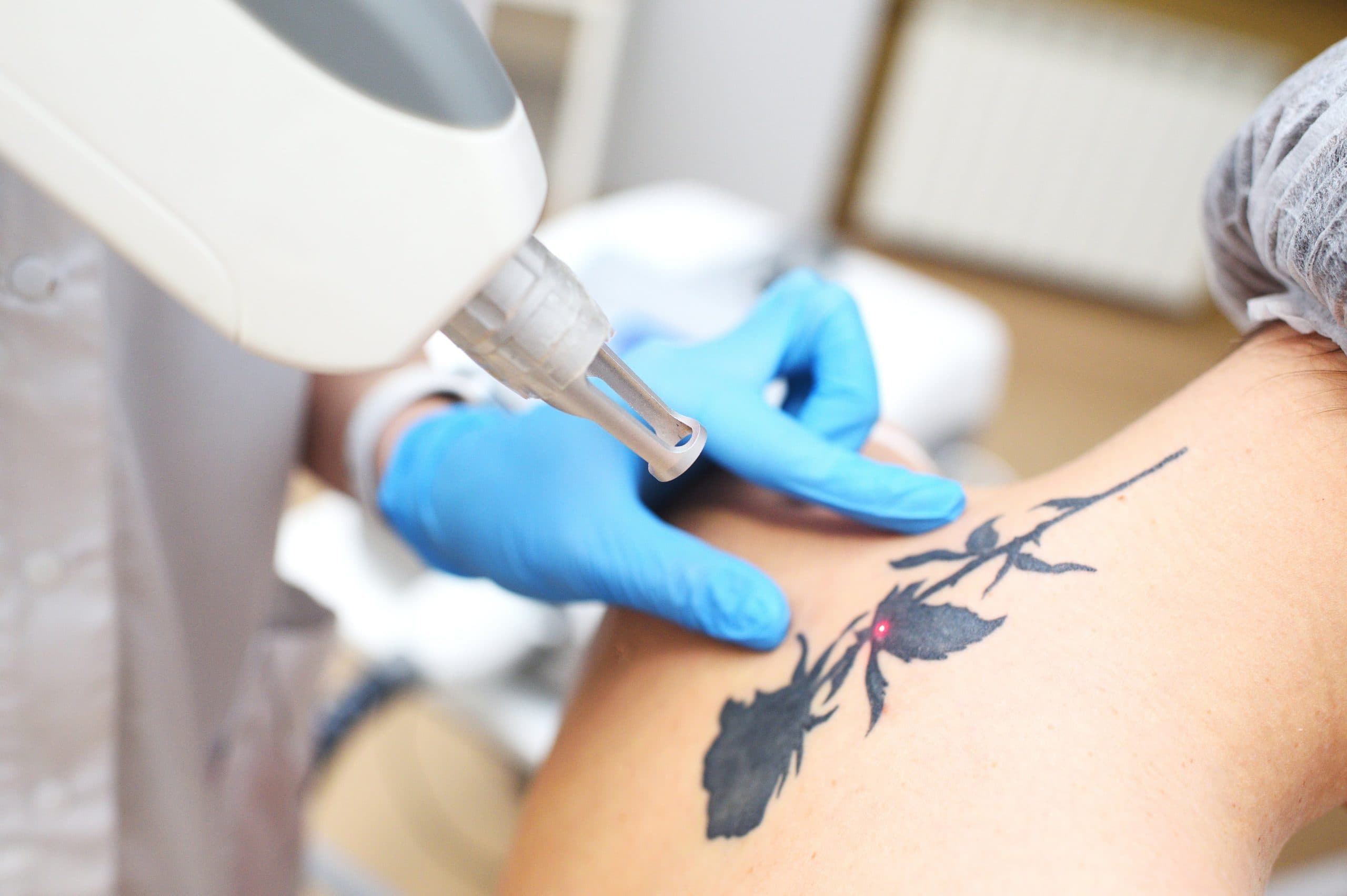 Tattoo removal